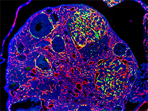 В одном случае первичная опухоль почки распространилась на яичник. Вирусные векторы, собравшиеся в сосудах метастатической опухоли, светятся зеленым. Красное окрашивание показывает нормальные кровеносные сосуды яичника.