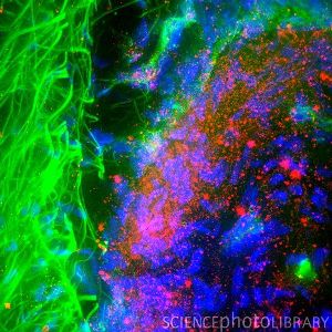 Болезнь Паркинсона. Флуоресцентная микрофотография разреза головного мозга. Ядра нейронов показаны синим, белок альфа-синуклеин – красным. Считается, что причиной прогрессирующей дегенерации нейронов, ведущей к симптомам болезни Паркинсона, является накопление именно этого белка.  F-актин в дендритах нейронов, отростках, собирающих информацию от других нервных клеток, показан зеленым.