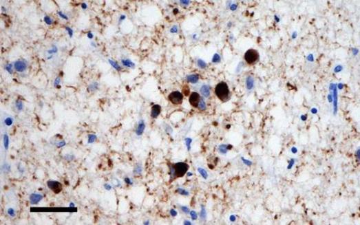 Клетки коры головного мозга с тельцами Леви, образованными альфа-синуклеином.