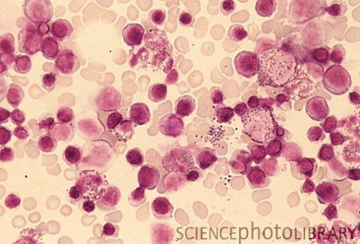 Костный мозг. Световая микрофотография стволовых клеток, дающих начало клеткам крови. Белые клетки крови – большие, фиолетовые, красные клетки крови – бледные, тромбоциты – маленькие фиолетовые гранулы. Клетки крови постоянно образуются в костном мозге, так как срок их жизни очень короток. Красные клетки,  тромбоциты  и все три вида белых клеток (гранулоциты, лимфоциты и моноциты) происходят от одной предковой клетки – мультипотентной стволовой клетки.