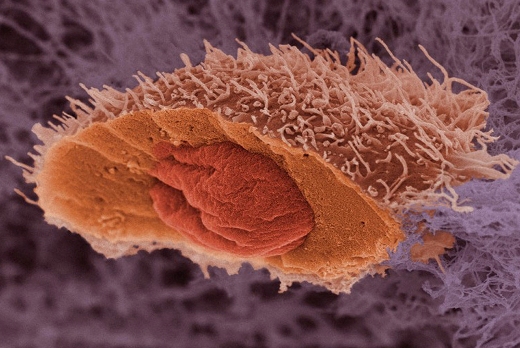 Плоскоклеточный рак кожи. Клетка заморожена, а затем вскрыта, чтобы показать ядро. (Сканирующая электронная микроскопия).