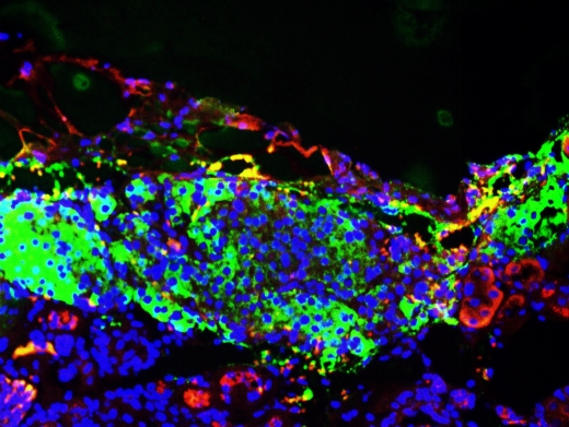 Из клеток пациента ученые из Института Солка создали бета-клетки поджелудочной железы, способные отвечать на глюкагон (красный) и продуцировать инсулин (зеленый). Эти клетки можно трансплантировать в организм пациента для лечения диабета.