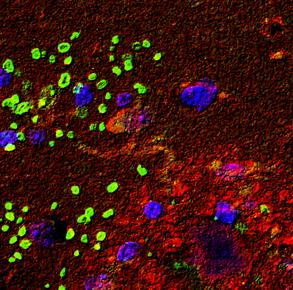 Сенильная бляшка (красная) и рилин (зеленый) в мозге мыши с моделью болезни Альцгеймера