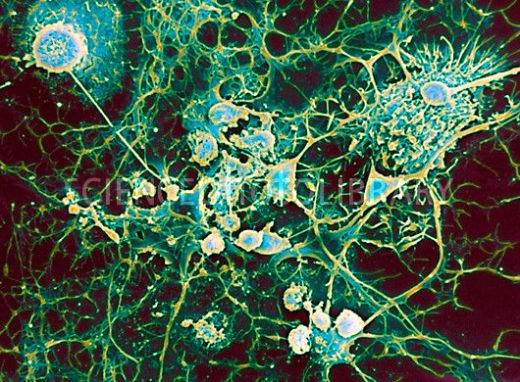 Клетки микроглии (круглые) поглощают олигодендроциты (разветвленные). Этот процесс, как полагают, идет при рассеянном склерозе. Олигодендроциты образуют изолирующие миелиновые оболочки вокруг аксонов в центральной нервной системе. Микроглия в норме поглощает клеточный мусор и бактерии как часть иммунного ответа организма. При рассеянном склерозе она атакует олигодендроциты, что, возможно, провоцируется вирусом, у людей с наследственной предрасположенностью. Разрушение миелиновой оболочки приводит к потере функции нерва. (SEM)