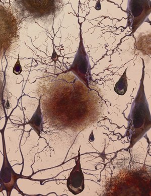 Художественное изображение потери связей между нервными клетками