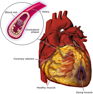 Образовавшийся в коронарной артерии тромб блокирует кровоток и приводит к гибели участка сердечной мышцы. Погибшая сердечная мышца практически не восстанавливаются и замещаются рубцовой тканью, снижая способность органа перекачивать кровь. Репопуляция поврежденного сердца новыми функциональными кардиомиоцитами остается для регенеративной медицины сложной задачей. Успешные эксперименты по прямому перепрограммированию фибробластов рубцовой ткани в кардиомиоциты с помощью микроРНК прямо в сердце мышей, возможно, устранят одного из препятствий на пути развития регенеративной медицины сердца - необходимость трансплантации стволовых клеток.