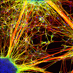 Нейроны, дифференцированные из индуцированных плюрипотентных стволовых клеток, полученных из клеток кожи больных шизофренией, образуют меньше связей, чем полученные из клеток здоровых людей.