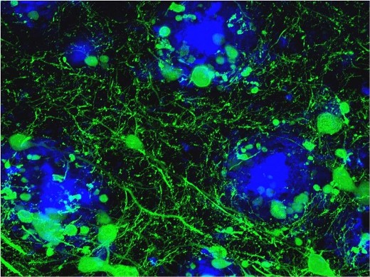 Патологические изменения в нервных процессах (показано зеленым) на границе бета-амилоидных бляшек (синие) в мозге живой трансгенной мыши с моделью болезни Альцгеймера.