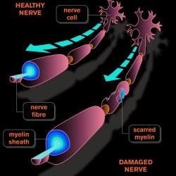 При повреждении миелиновой оболочки значительно снижается скорость передачи электрического импульса по нервному волокну.
