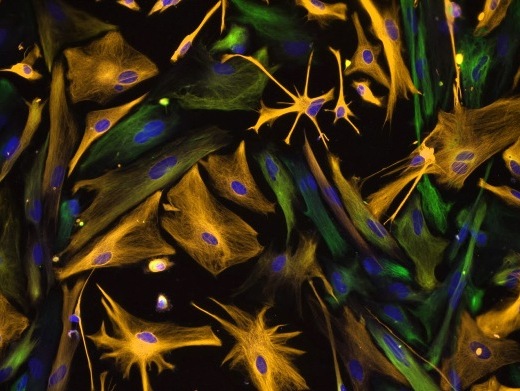 Человеческие нейральные клетки-предшественники, выделенные из развивающегося человеческого мозга и направленные по пути линейной дифференциации. Нейральные клетки-предшественники окрашены зеленым; дифференцированные астроциты – оранжевым; ядра – синим.