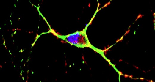 Нейрон, выделенный из мозга мыши с моделью болезни Хантингтона. Митохондрии помечены красным и зеленым, ядро – синим.