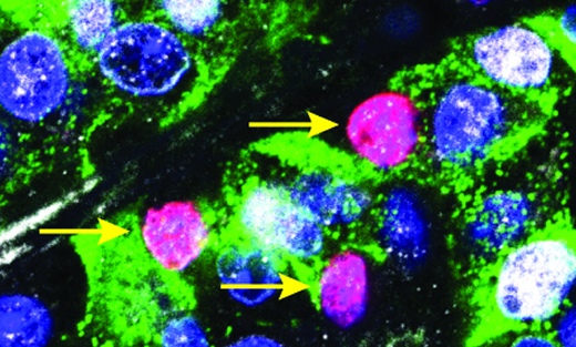 В  бета-клетках с подавленным p57 ДНК может реплицироваться. Розовым  показано ядро, прошедшее репликацию ДНК, зеленым – инсулин, синим –  ядра, окрашенные по ДНК, белым – p57.