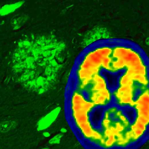 Патология головного мозга при болезни Альцгеймера выявляется с помощью тиофлавин-S флуоресцентной микроскопии, показывающей как нейрофибриллярные клубки (пламевидные структуры), так и амилоидные бляшки  (округлые структуры). Сканирование мозга позволяет визуализировать накопление амилоида в мозге живых лиц  (на амилоид указывают более теплые цвета).