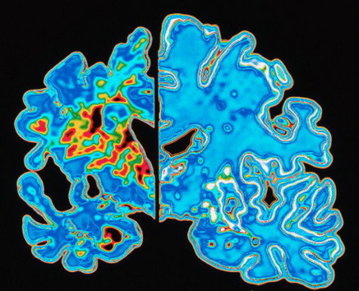 Мозг человека с болезнью Альцгеймера (слева) и мозг здорового человека.