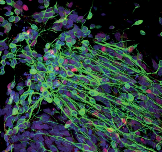 Колония нейронов, полученных из клеток пуповинной крови с использованием технологии перепрограммирования стволовых клеток. Зеленое и красное свечение означает, что эти клетки вырабатывают белковые маркеры нейронов – доказательство того, что клетки пуповинной крови действительно трансформировались в нейроны. Голубым светятся ядра нейронов.2