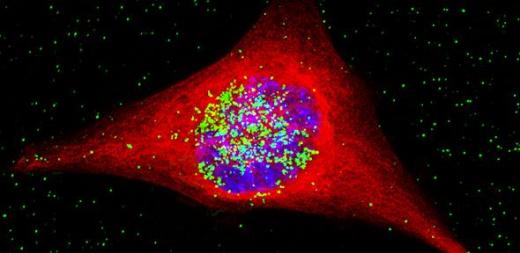 Раковая клетка с содержащимися в ее ядре (синее) наночастицами золота (зеленые).