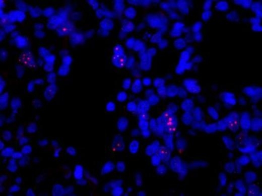 Флуоресцентное окрашивание аномальной ДНК теломер в клетках нейроэктодермальной опухоли поджелудочной железы.