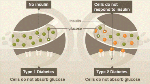 При обеих основных формах сахарного диабета клетки не могут усваивать находящуюся в крови глюкозу. При юношеском диабете 1 типа необходимый для усвоения глюкозы гормон инсулин не вырабатывается из-за гибели синтезирующих его клеток поджелудочной железы. При диабете 2 типа тканевые клетки не отвечают на присутствие инсулина – так называемая инсулиновая резистентность.