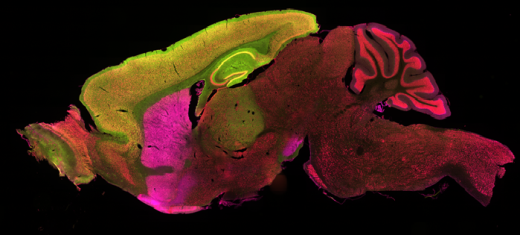 Цветное  изображение головного мозга мыши. Кора показана желтым,  полосатое тело  –  розовым. Болезнь Хантингтона уменьшает объем мозга, убивая клетки в  этих двух областях.