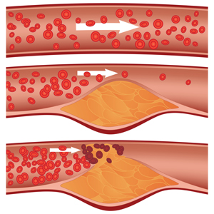 Мультипотентные сосудистые стволовые клетки вносят вклад в стенозирование сосудов при таких заболеваниях, как атеросклероз. На рисунке верхняя артерия здорова, в то время как в средней и нижней образуется бляшка, препятствующая кровотоку.